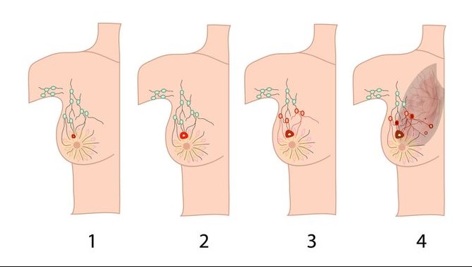 Santapan Pemicu Tumor Buah Dada Ganas